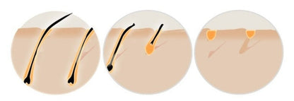 HexoSkin™ At-Home IPL Laser Hair Removal Device