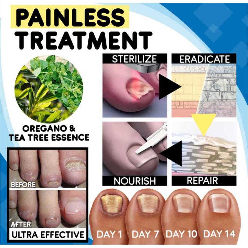HexoNail™ Fungus Treatment Kit