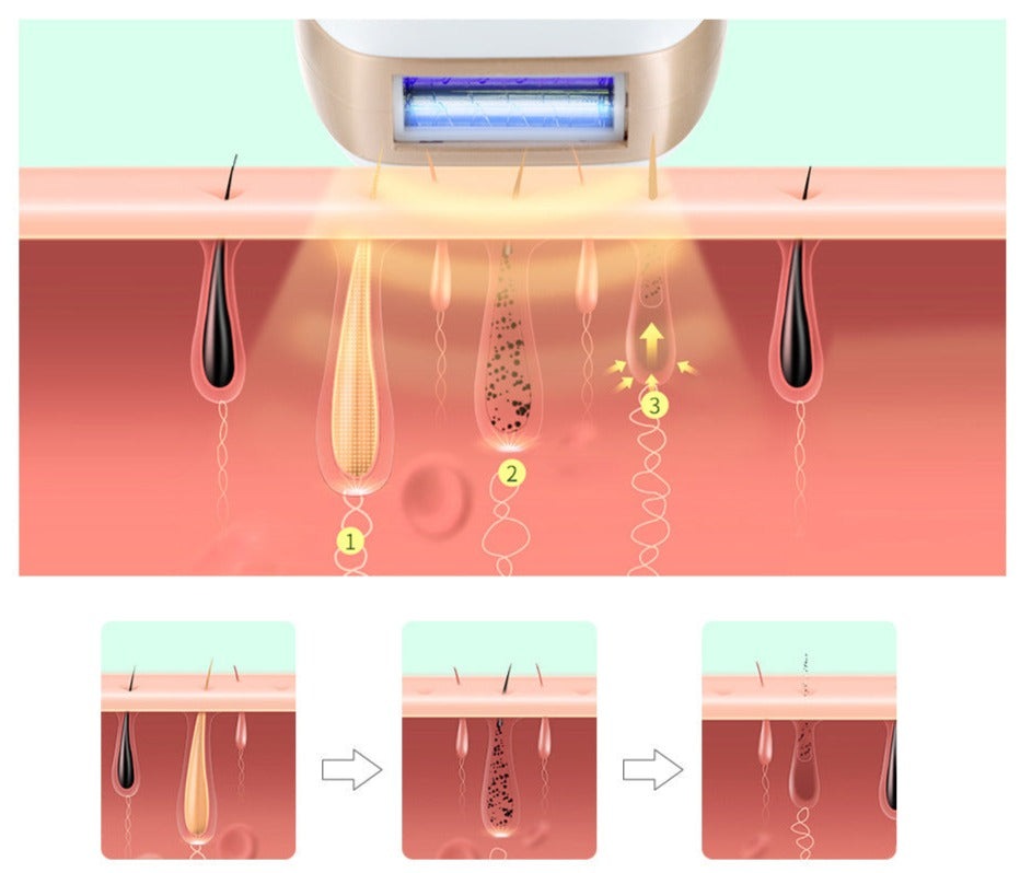 HexoSkin™ IPL Laser Hair Removal Device